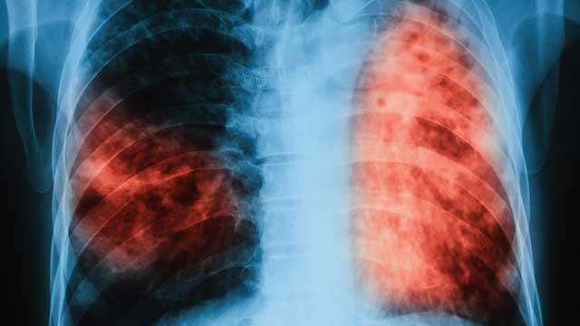 Forskare har hittat ny antibiotikaresistent stam av tuberkulos bland asylsökare