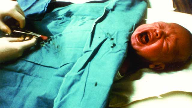 Forskare larmar: Omskärelse av nyfödda pojkar ökar risken för plötslig spädbarnsdöd