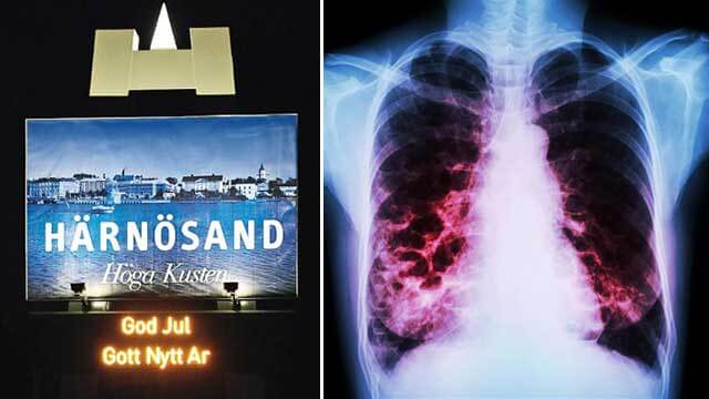 Smittlarm i Härnösand efter att skolelev insjuknat i TBC