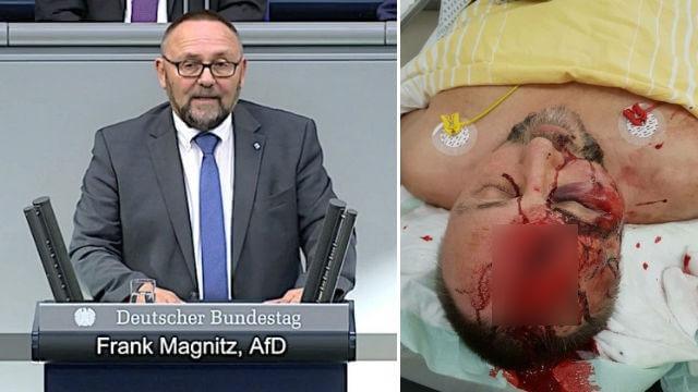 Mordförsök på Alternativ För Tysklands toppolitiker – misshandlades med träpåk