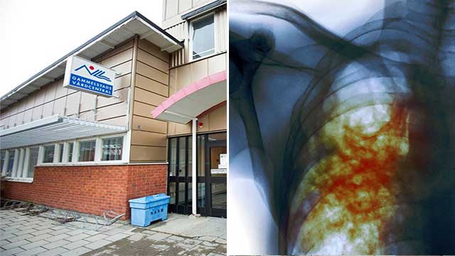 Sex nya fall av TBC-smitta påträffade i Luleå – ytterligare spridning befaras