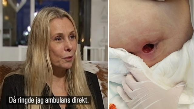 78-årig rörelsehindrad kvinna låg med infekterat sår i en månad – ”Man såg ryggraden”