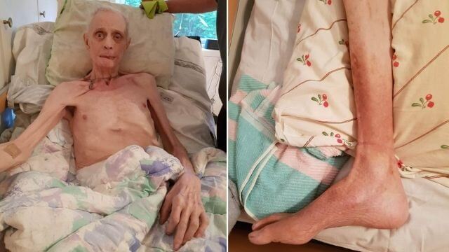 Avmagrad 81-åring får gammal mat och sover i avföring  – vädjar efter hjälp