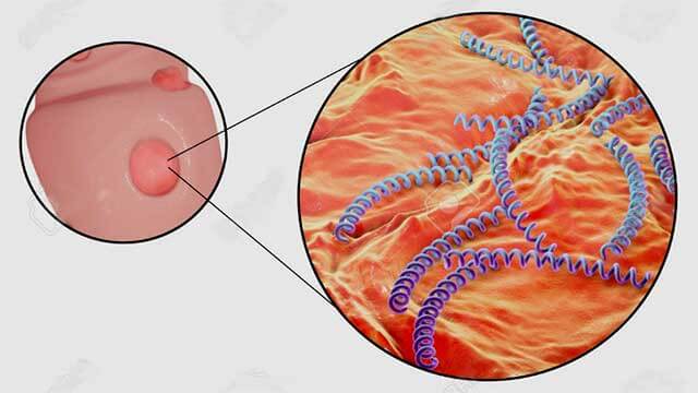 Kraftig ökning av könssjukdomen syfilis – homosexuella män hårdast drabbade