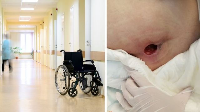 Kvinnas infekterade liggsår glömdes bort på äldreboende – avled