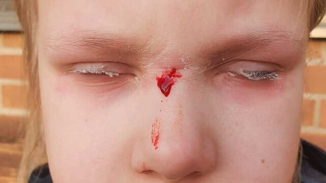 7-åring till vårdcentral efter olycka – fick ögonlocken limmade