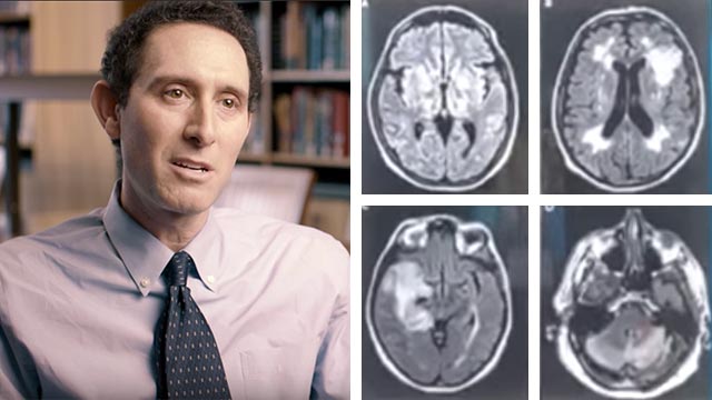 Forskare bekräftar: Covid-19 kan orsaka hjärnskador