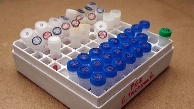 Åratal att komma ikapp missade cancertester på grund av coronaviruset