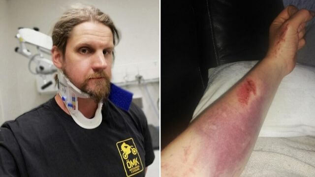 Läkare bedömde bruten nacke som nackspärr – skickades hem med värktabletter