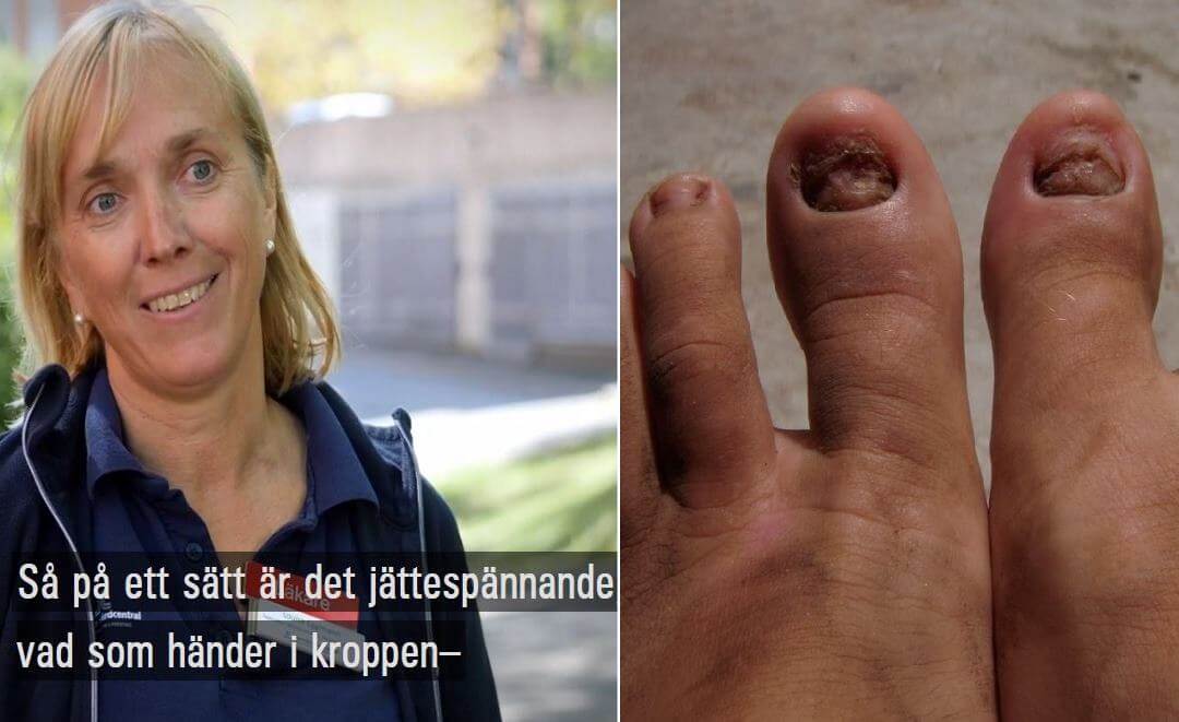 Statstelevisionen om nya coronasymptom: ”Jättespännande” när tånaglar faller av