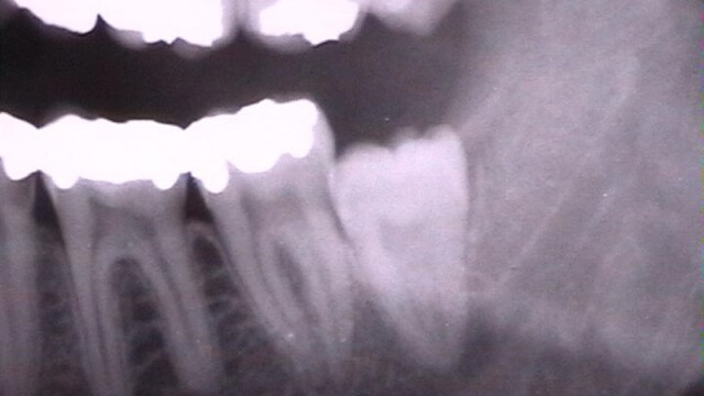 Får asyl för att visdomstand inte har uppnått slutstadiet