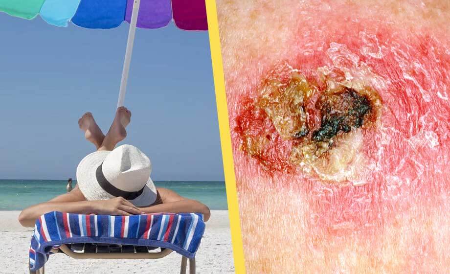 Rekordökning av hudcancer i Sverige – bara Australien och Nya Zeeland före