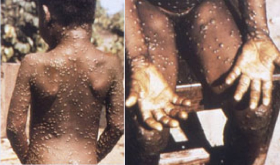 Apkoppor sprider sig bland homosexuella i Sverige