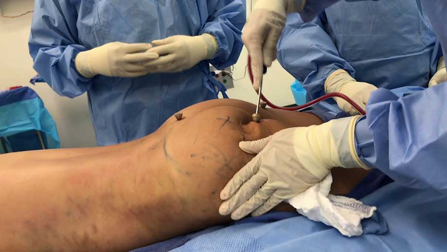 Oskickliga skönhetsoperationer i utlandet tränger undan vård i Sverige