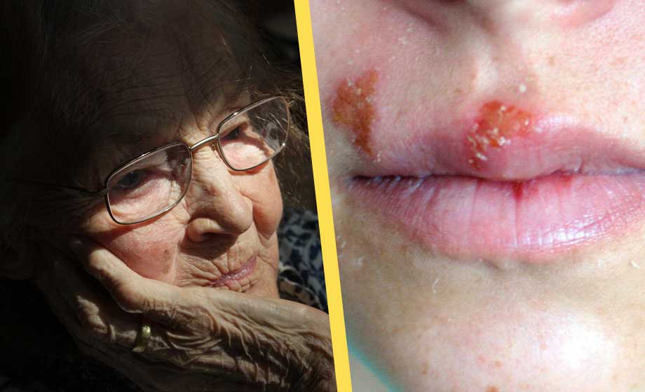 Munsår ger fördubblad risk för demens