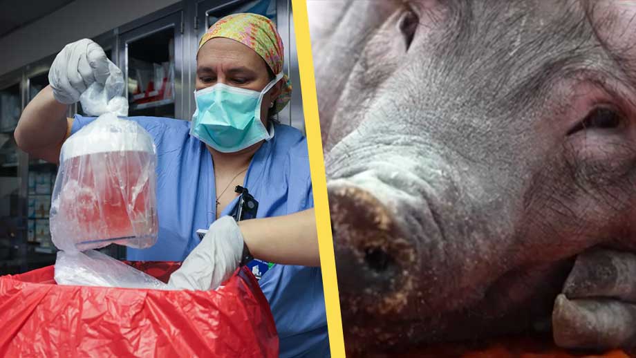 Första lyckade transplantationen med grisnjure