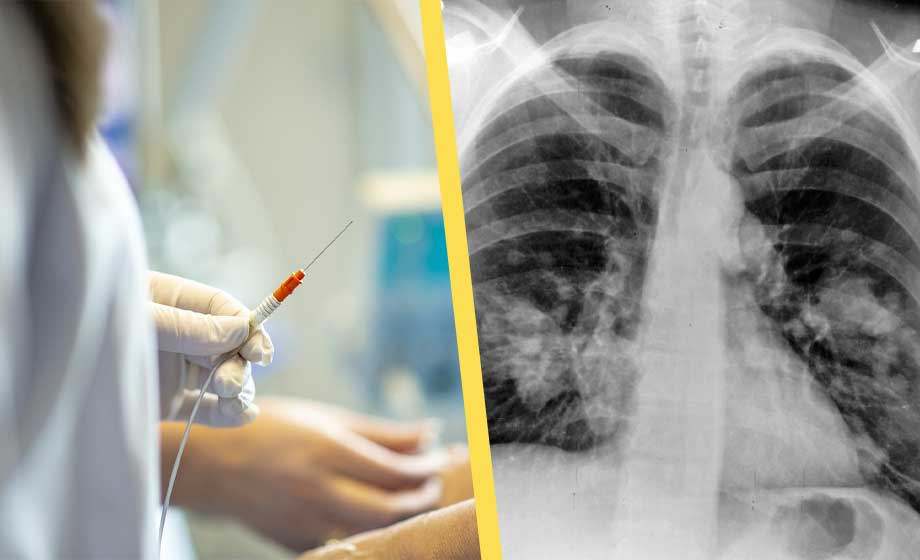 Vaccin mot lungcancer använder mRNA-teknologi