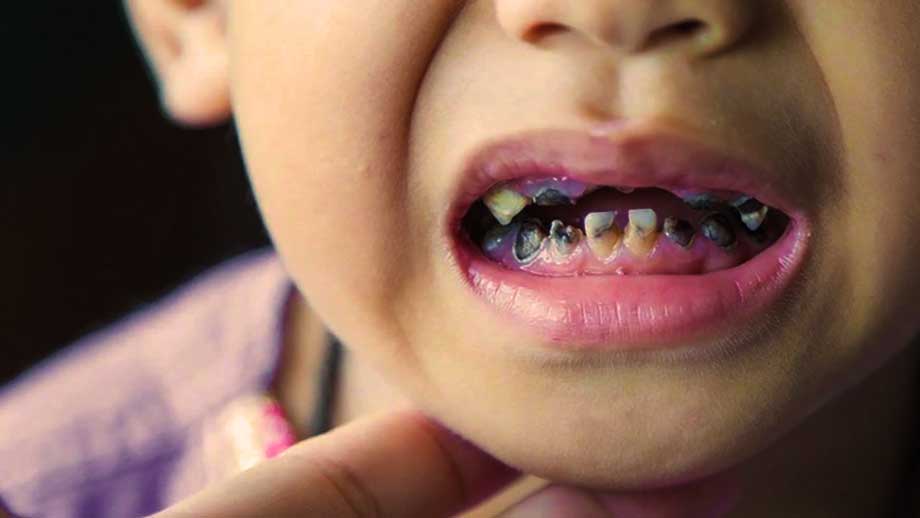 Urusel tandhälsa hos migrantbarn – skapar långa köer och höga kostnader